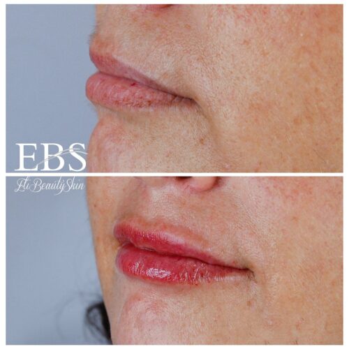 EBS EliBeautySkin - Dermopigmentazione (Prima-Dopo) #2 (2)